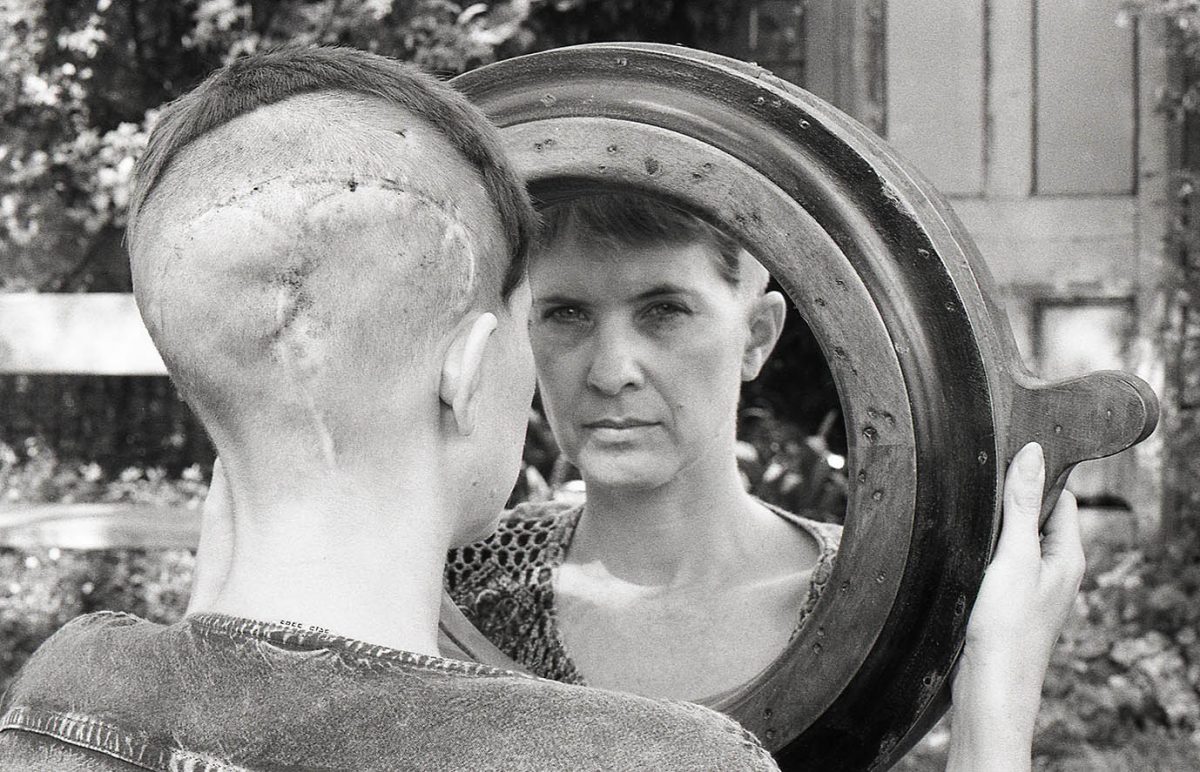 Anne Howell in 1999 looking in the mirror at the scar from surgery on her skull.