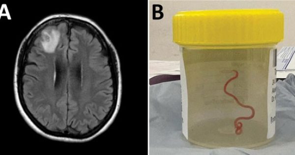 Neurosurgeon finds worm in woman's brain 'alive and wriggling'