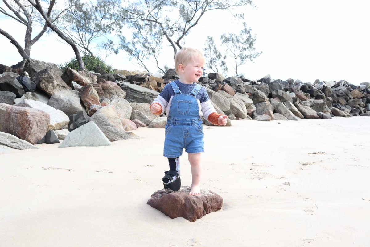 A toddler with Congenital Femoral Deficiency smiles as he stands on a rock at the beach