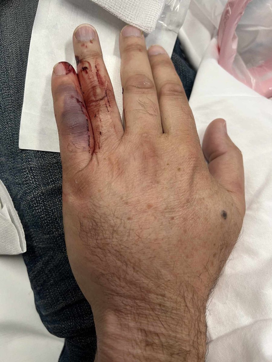 Man's swollen hand after snake bite