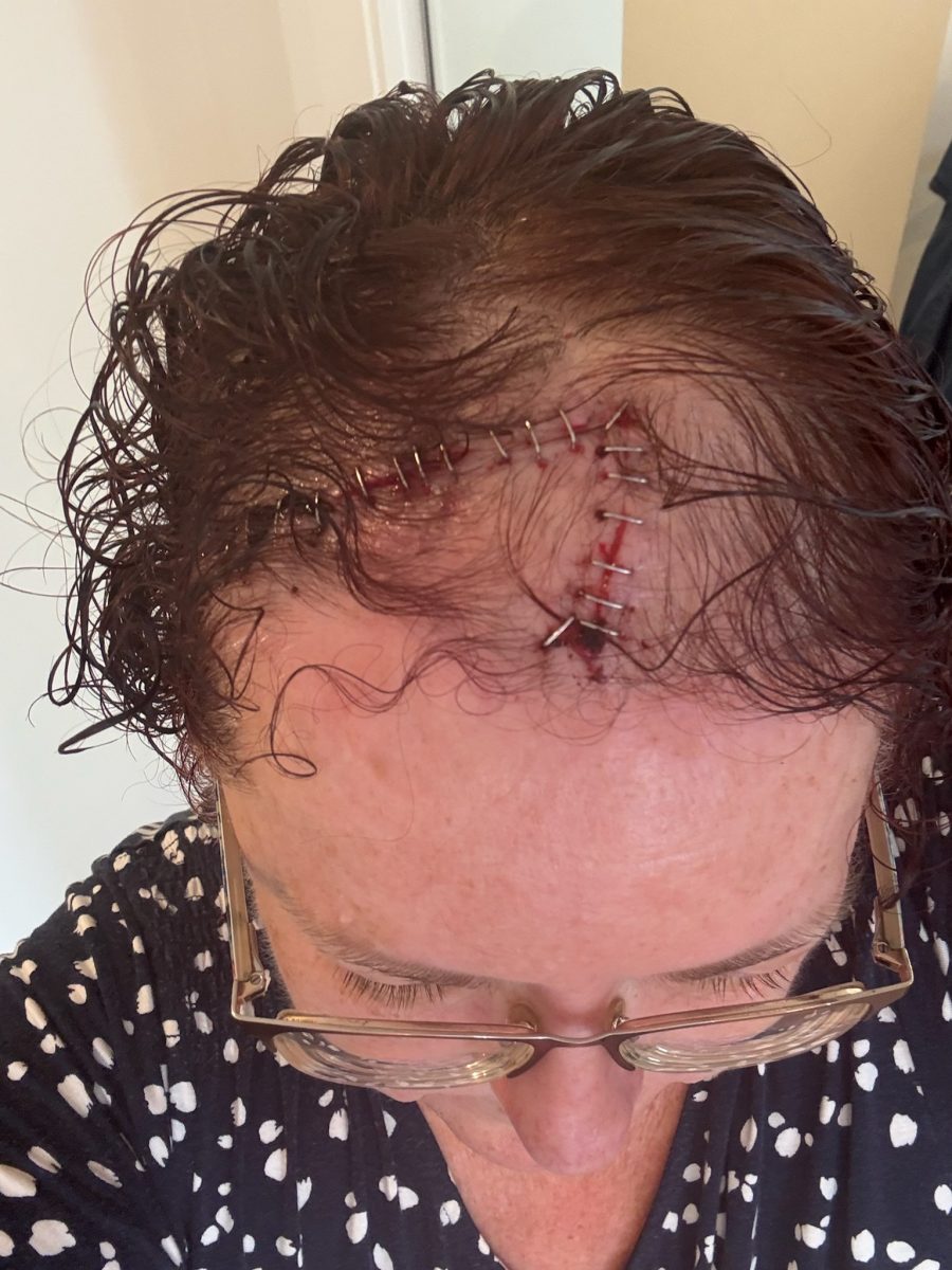 Wollongong Lord Mayor Tania Brown with head scar stapled